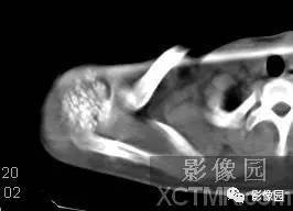 【病例】右肩关节滑膜骨软骨瘤病1例X线CT影像诊断分析 【病例】右肩关节滑膜骨软骨瘤病1例X线CT影像诊断分析
