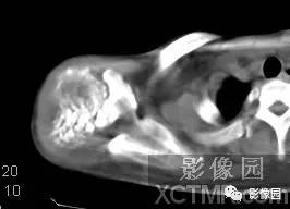 【病例】右肩关节滑膜骨软骨瘤病1例X线CT影像诊断分析 【病例】右肩关节滑膜骨软骨瘤病1例X线CT影像诊断分析