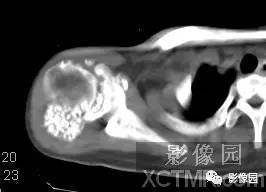 【病例】右肩关节滑膜骨软骨瘤病1例X线CT影像诊断分析 【病例】右肩关节滑膜骨软骨瘤病1例X线CT影像诊断分析