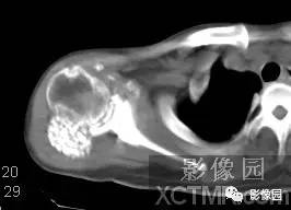 【病例】右肩关节滑膜骨软骨瘤病1例X线CT影像诊断分析 【病例】右肩关节滑膜骨软骨瘤病1例X线CT影像诊断分析