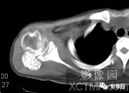 【病例】右肩关节滑膜骨软骨瘤病1例X线CT影像诊断分析 【病例】右肩关节滑膜骨软骨瘤病1例X线CT影像诊断分析