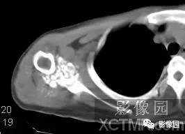 【病例】右肩关节滑膜骨软骨瘤病1例X线CT影像诊断分析 【病例】右肩关节滑膜骨软骨瘤病1例X线CT影像诊断分析