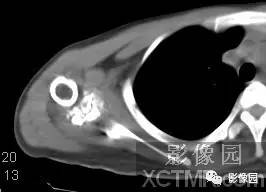 【病例】右肩关节滑膜骨软骨瘤病1例X线CT影像诊断分析 【病例】右肩关节滑膜骨软骨瘤病1例X线CT影像诊断分析