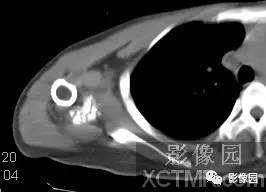 【病例】右肩关节滑膜骨软骨瘤病1例X线CT影像诊断分析 【病例】右肩关节滑膜骨软骨瘤病1例X线CT影像诊断分析
