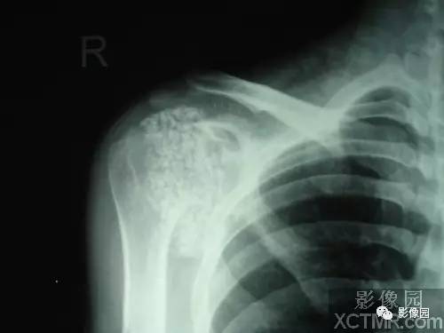 【病例】右肩关节滑膜骨软骨瘤病1例X线CT影像诊断分析 【病例】右肩关节滑膜骨软骨瘤病1例X线CT影像诊断分析