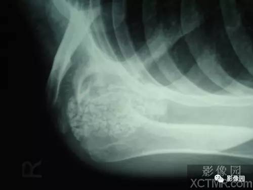 【病例】右肩关节滑膜骨软骨瘤病1例X线CT影像诊断分析 【病例】右肩关节滑膜骨软骨瘤病1例X线CT影像诊断分析
