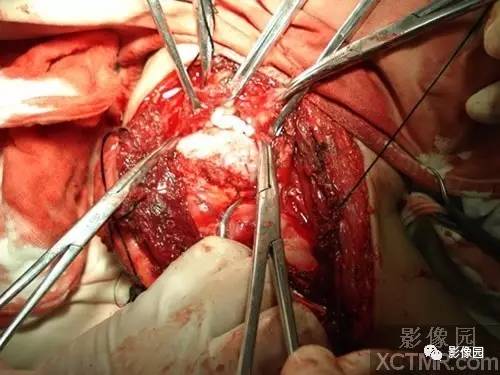 【病例】右肩关节滑膜骨软骨瘤病1例X线CT影像诊断分析 【病例】右肩关节滑膜骨软骨瘤病1例X线CT影像诊断分析