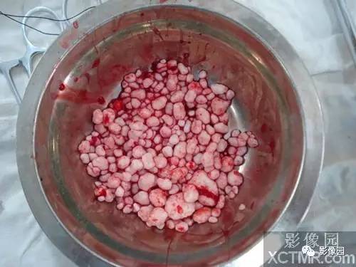 【病例】右肩关节滑膜骨软骨瘤病1例X线CT影像诊断分析 【病例】右肩关节滑膜骨软骨瘤病1例X线CT影像诊断分析