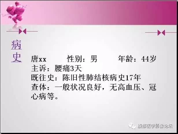 【病例】左侧肾上腺髓样脂肪瘤1例CT及MR