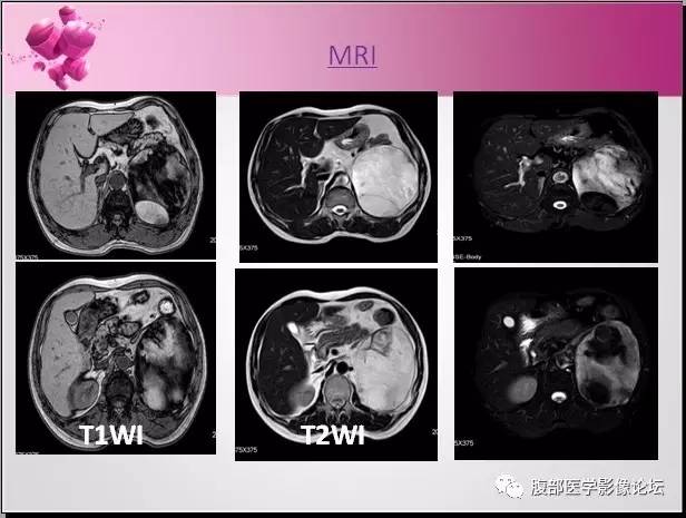 【病例】左侧肾上腺髓样脂肪瘤1例CT及MR