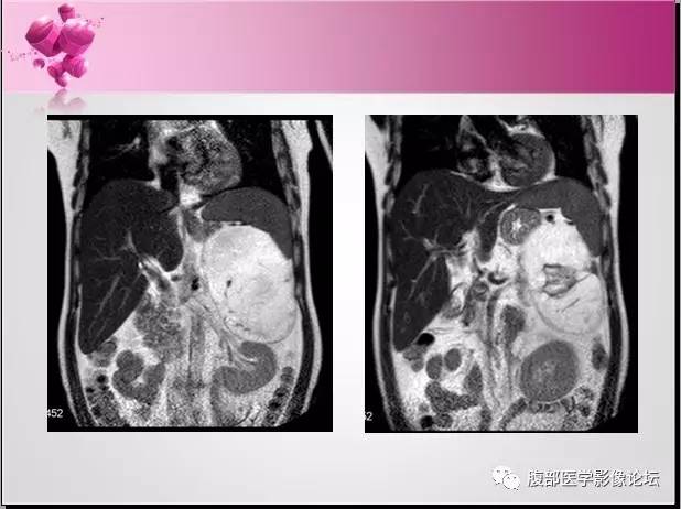 【病例】左侧肾上腺髓样脂肪瘤1例CT及MR
