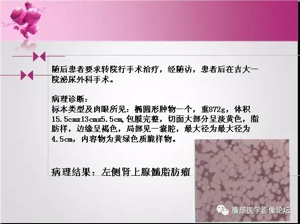 【病例】左侧肾上腺髓样脂肪瘤1例CT及MR