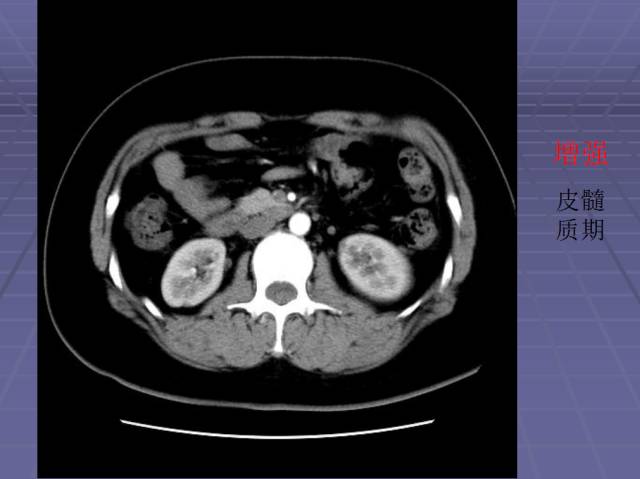 【病例】局灶性肾盂肾炎1例CT影像表现