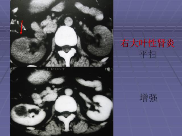 【病例】局灶性肾盂肾炎1例CT影像表现