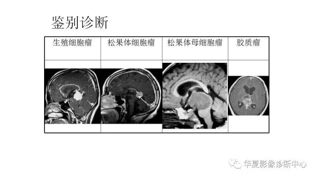 【病例】松果体区畸胎瘤1例CT及MR影像表现