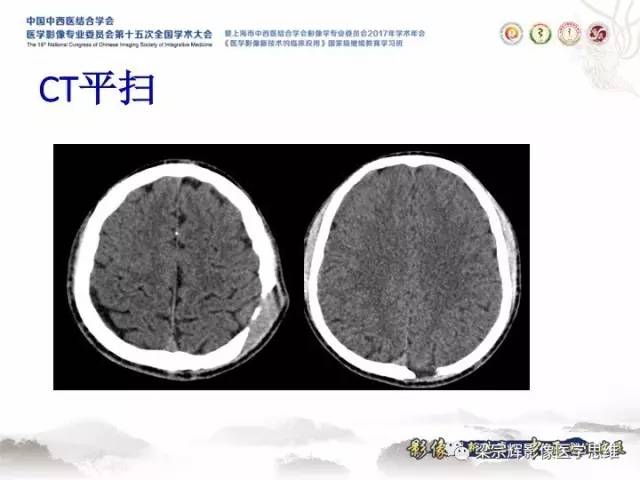 【病例】颅骨嗜酸性肉芽肿1例CT及MR影像表现