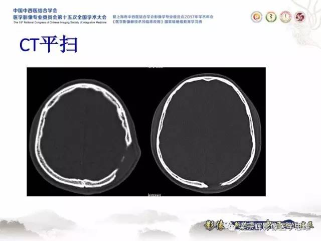 【病例】颅骨嗜酸性肉芽肿1例CT及MR影像表现