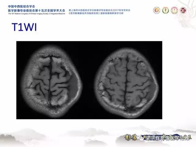 【病例】颅骨嗜酸性肉芽肿1例CT及MR影像表现