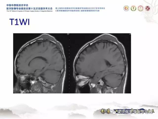 【病例】颅骨嗜酸性肉芽肿1例CT及MR影像表现