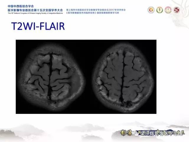 【病例】颅骨嗜酸性肉芽肿1例CT及MR影像表现