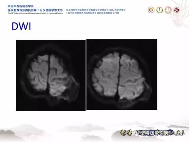 【病例】颅骨嗜酸性肉芽肿1例CT及MR影像表现