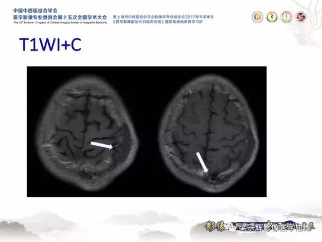 【病例】颅骨嗜酸性肉芽肿1例CT及MR影像表现