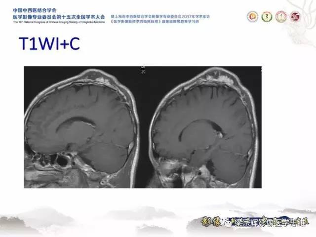 【病例】颅骨嗜酸性肉芽肿1例CT及MR影像表现