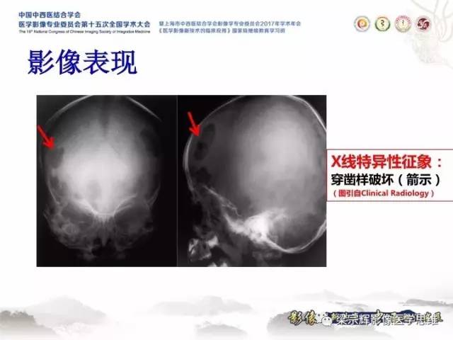 【病例】颅骨嗜酸性肉芽肿1例CT及MR影像表现