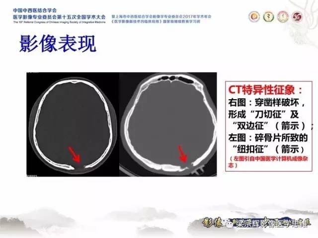 【病例】颅骨嗜酸性肉芽肿1例CT及MR影像表现