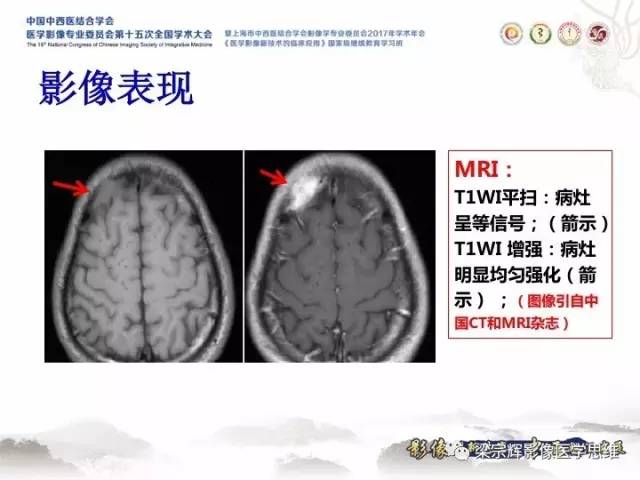 【病例】颅骨嗜酸性肉芽肿1例CT及MR影像表现
