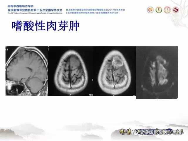 【病例】颅骨嗜酸性肉芽肿1例CT及MR影像表现