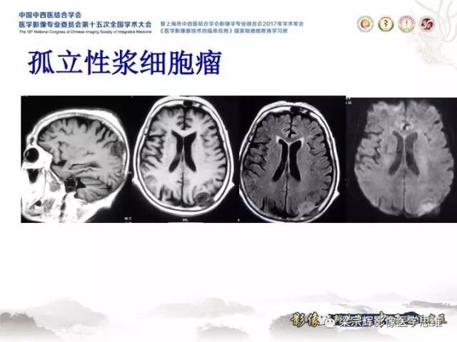 【病例】颅骨嗜酸性肉芽肿1例CT及MR影像表现
