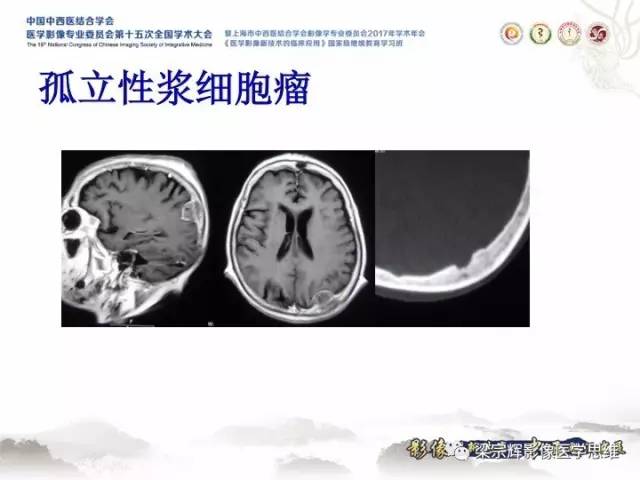 【病例】颅骨嗜酸性肉芽肿1例CT及MR影像表现