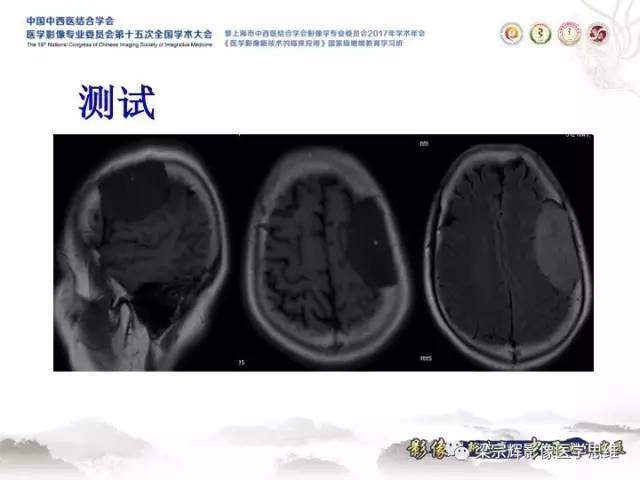 【病例】颅骨嗜酸性肉芽肿1例CT及MR影像表现