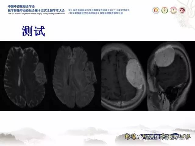 【病例】颅骨嗜酸性肉芽肿1例CT及MR影像表现