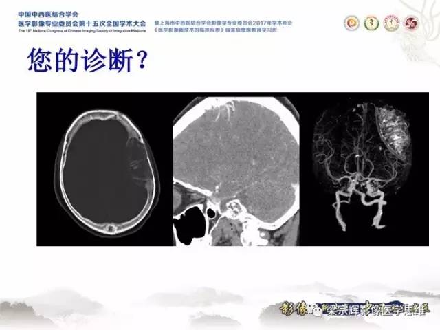 【病例】颅骨嗜酸性肉芽肿1例CT及MR影像表现