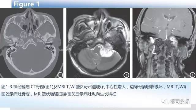 【PPT】头颈部副神经节瘤影像诊断