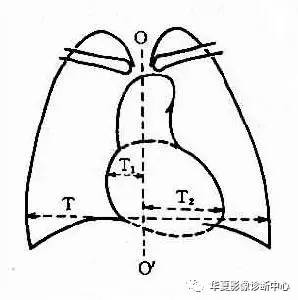 心胸比率你测量对了吗？