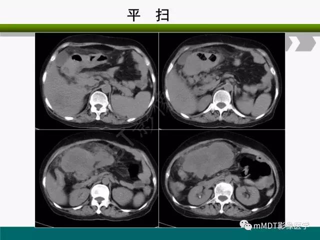 【PPT】胃外生性肿瘤的诊断与鉴别诊断