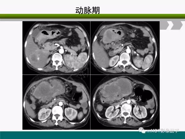 【PPT】胃外生性肿瘤的诊断与鉴别诊断