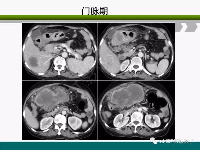 【PPT】胃外生性肿瘤的诊断与鉴别诊断
