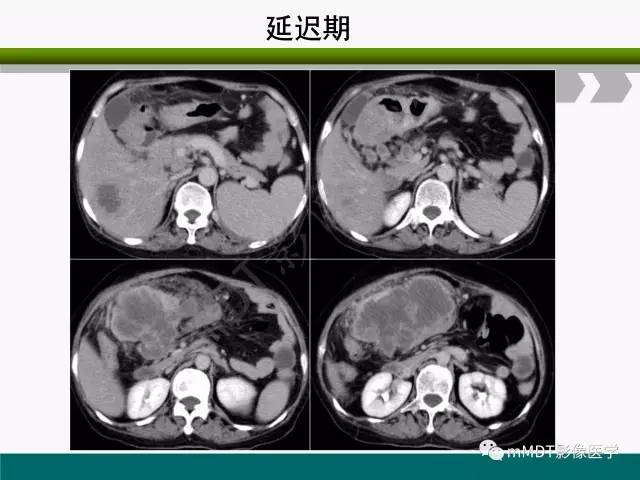 【PPT】胃外生性肿瘤的诊断与鉴别诊断