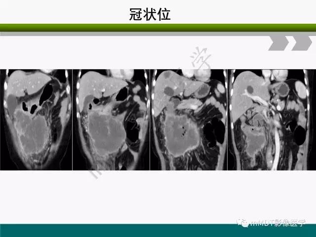 【PPT】胃外生性肿瘤的诊断与鉴别诊断