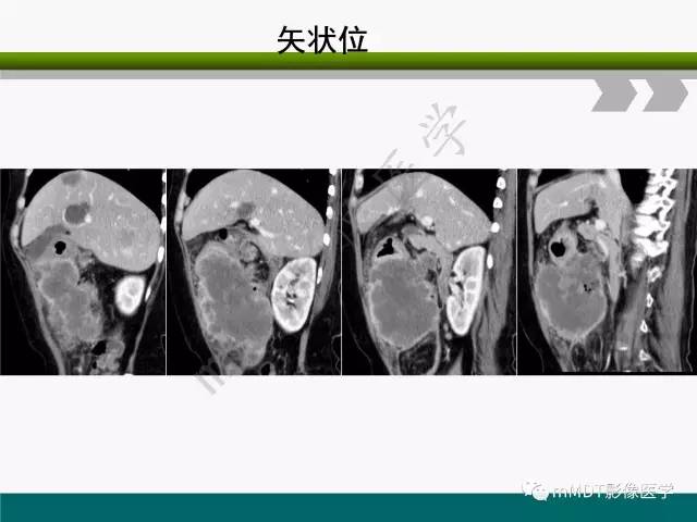 【PPT】胃外生性肿瘤的诊断与鉴别诊断