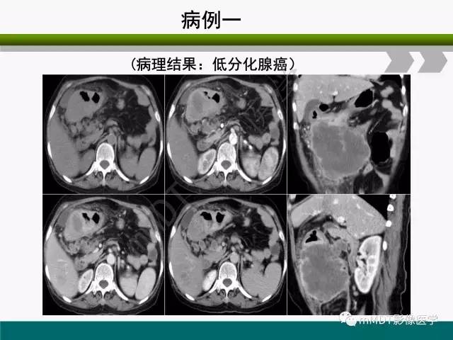 【PPT】胃外生性肿瘤的诊断与鉴别诊断