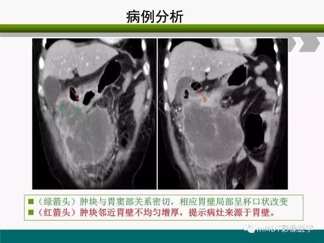 【PPT】胃外生性肿瘤的诊断与鉴别诊断