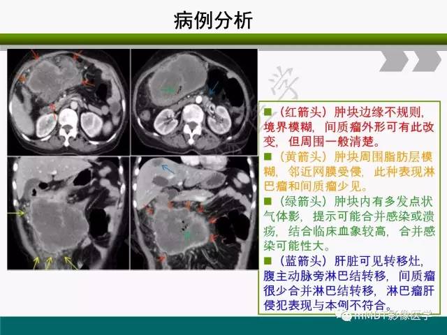 【PPT】胃外生性肿瘤的诊断与鉴别诊断