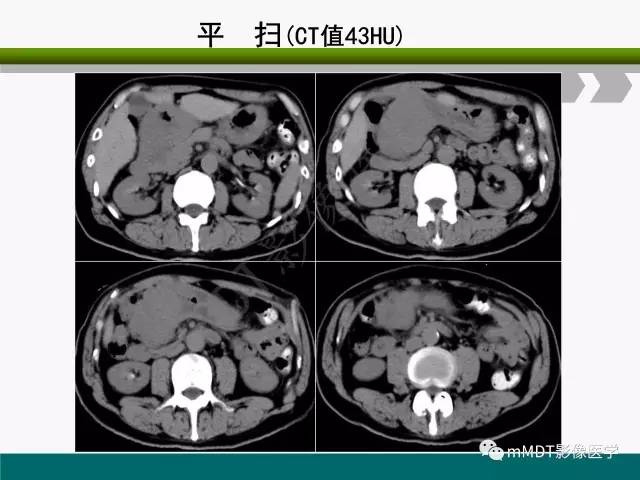 【PPT】胃外生性肿瘤的诊断与鉴别诊断