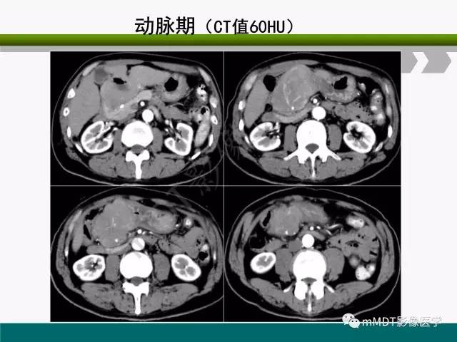 【PPT】胃外生性肿瘤的诊断与鉴别诊断