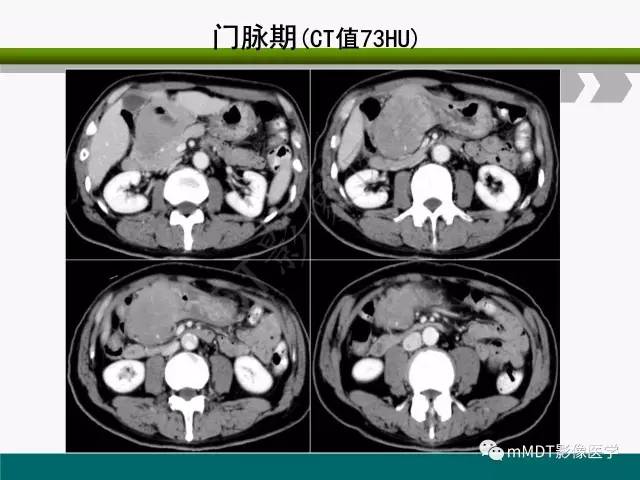 【PPT】胃外生性肿瘤的诊断与鉴别诊断